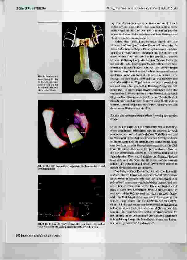 Vorschauseite 6: Einsatz der Gaumensegelprothese bei velopharyngealer Inkompetenz: Erfahrungen mit palatoflex™