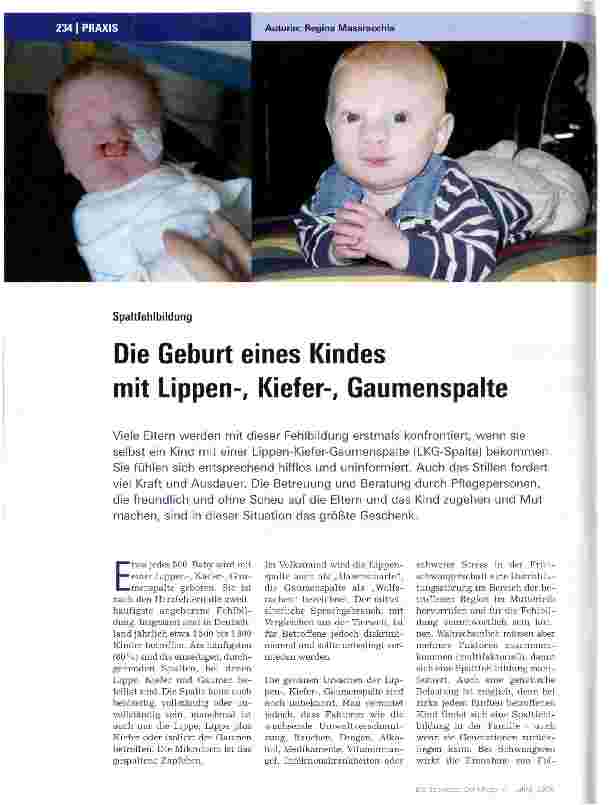 Vorschauseite 1: Die Geburt eines Kindes mit Lippen-, Kiefer-, Gaumenspalte