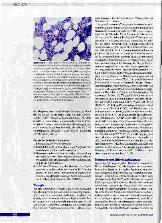 Vorschauseite 5: Die Mastozytose Eine Erkrankung der hämopoettschen Stammzell