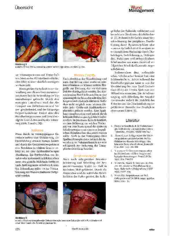 Vorschauseite 3: Wundmanagement nach Grenzzonenamputation und Minoramputationen