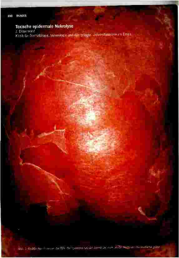 Vorschauseite 1: Toxische epidermale Nekrolyse