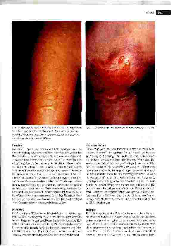 Vorschauseite 2: Toxische epidermale Nekrolyse