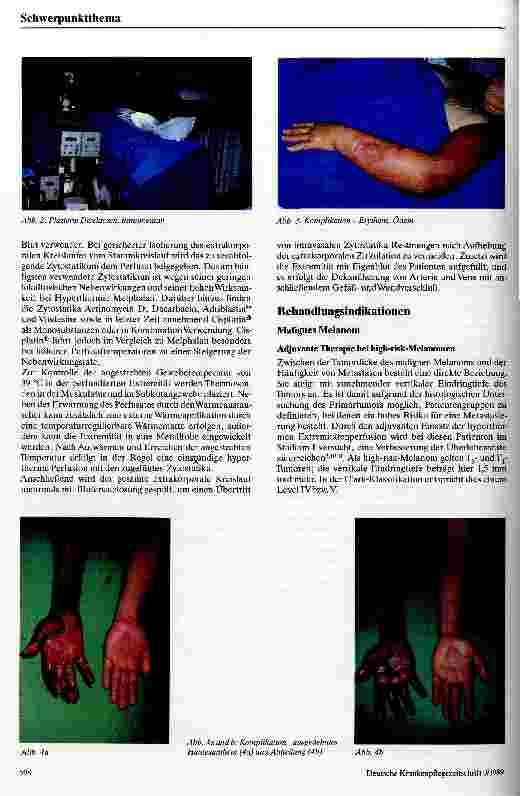Vorschauseite 2: Die isolierte hypertherme Extremitätenperfusion mit Zytostatika Eine Behandlungsmethode bei malignem Melanom und Weichteilsarkomen