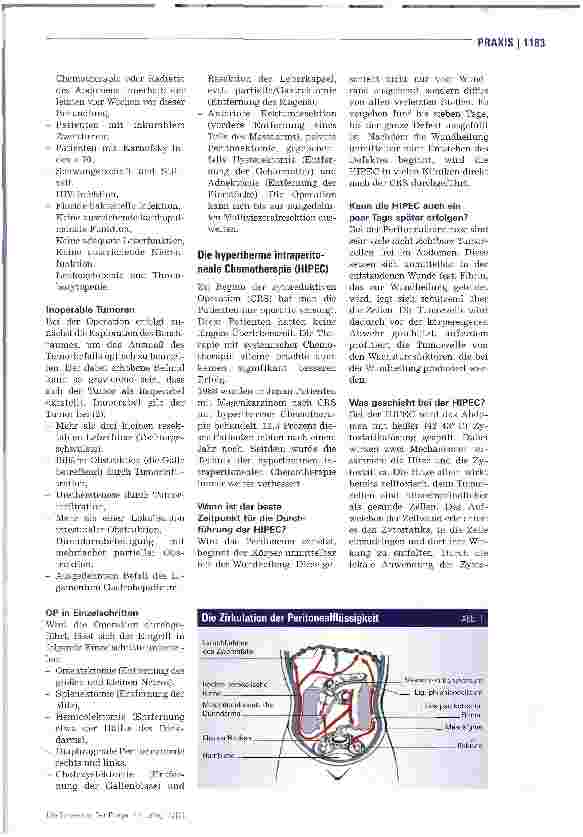 Vorschauseite 2: Behandlung der Peritonealkarzinome