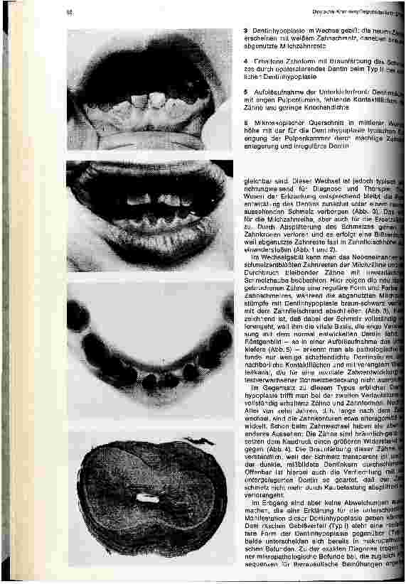 Vorschauseite 2: Erbliche Dentinhypoplasie an Milchund Ersatzzähnen