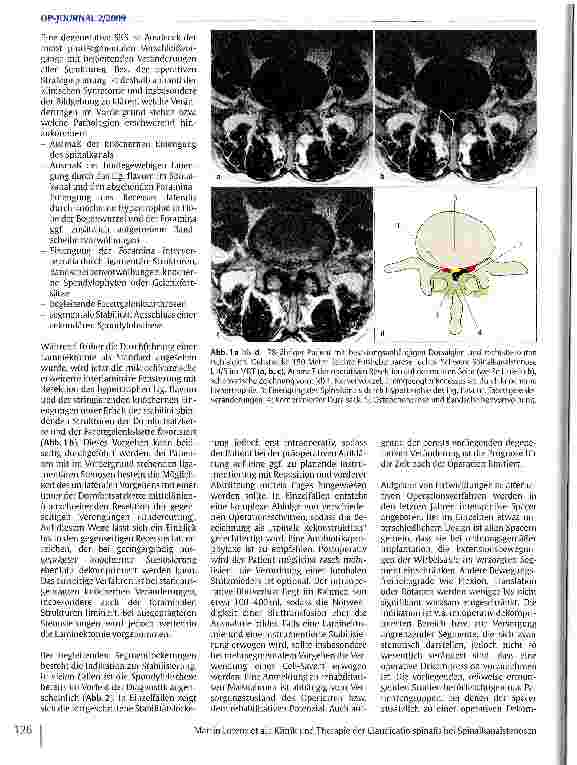 Vorschauseite 3: Klinik und Therapie der Claudicatio spinalis bei Spinalkanalstenosen