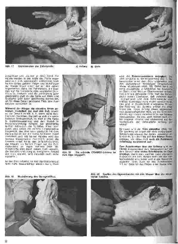 Vorschauseite 3: Grundlagen und Technik des Gipsverbandes 11. Folge: Fußgips nach OP eines Hallux valgus nach Brandes