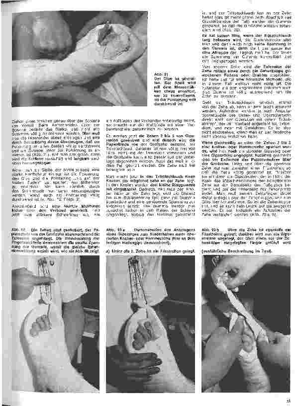Vorschauseite 4: Grundlagen und Technik des Gipsverbandes 11. Folge: Fußgips nach OP eines Hallux valgus nach Brandes