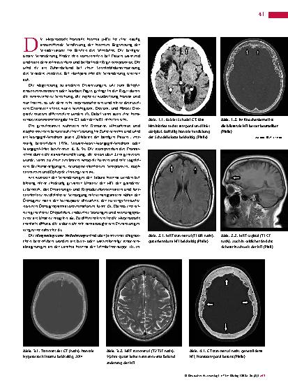 Vorschauseite 2: Anomalien und Normvarianten – Skelettale Veränderungen 3. 40: Hyperostosis frontalis interna