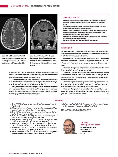 Vorschauseite 3: Anomalien und Normvarianten – Skelettale Veränderungen 3. 40: Hyperostosis frontalis interna