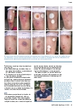Vorschauseite 2: Symptomatisch und schmerzlindernd – Wundversorgung bei Nekrobiosis lipoidica
