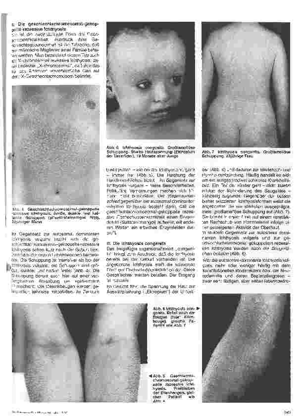 Vorschauseite 2: Hautärztliche Blick-Diagnose von Erbkrankheiten: Ichthyosis (Fischschuppenkrankheit)
