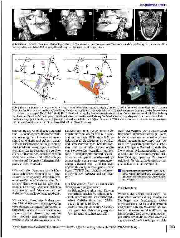 Vorschauseite 4: Osteotomien im Gesichtsskelett - Basis der orthognathen Chirurgie: Befunderhebung, präoperative Planung und individuelle Realisation bei Korrekturoperationen von Kieferund Gesicht…