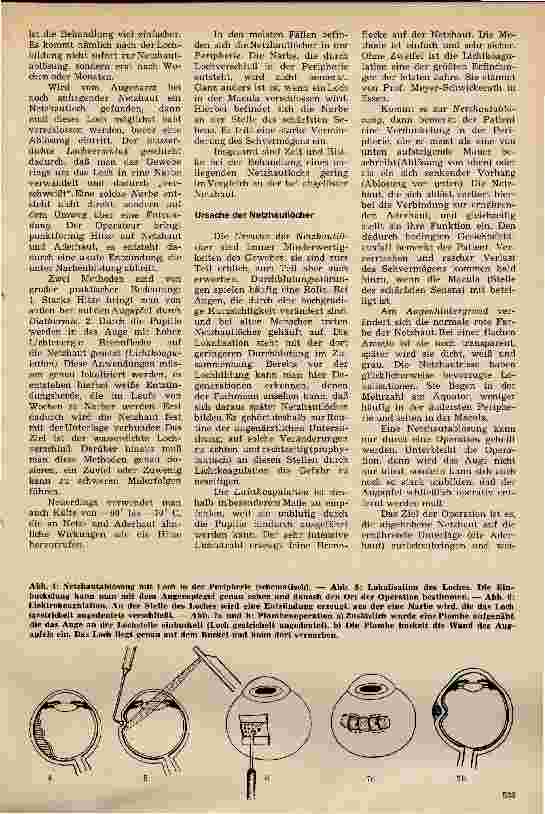 Vorschauseite 2: Netzhautablösung Ursache, Krankheitsbild und Behandlung