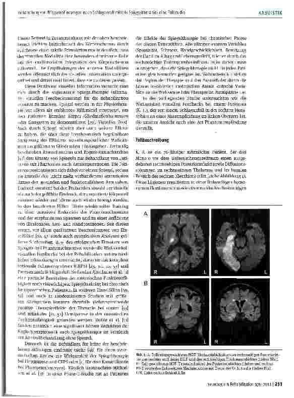 Vorschauseite 3: Behandlung von Missempfindungen nach Schlaganfall mittels Spiegeltherapie: eine Fallstudie