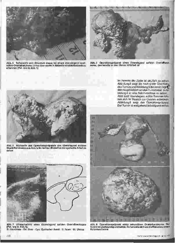 Vorschauseite 3: Ovarialkarzinom