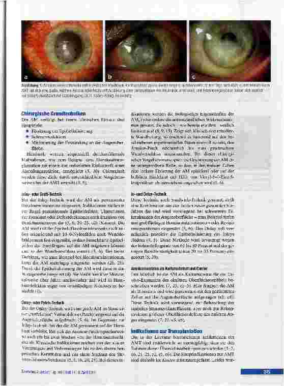 Vorschauseite 3: Amnionmembrantransplantation am menschlichen Auge