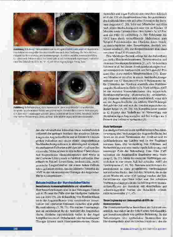 Vorschauseite 4: Amnionmembrantransplantation am menschlichen Auge
