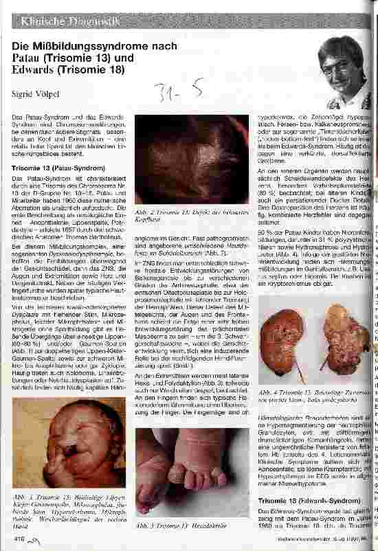 Vorschauseite 1: Die Mißbildungssyndrome nach Patau und Edwards