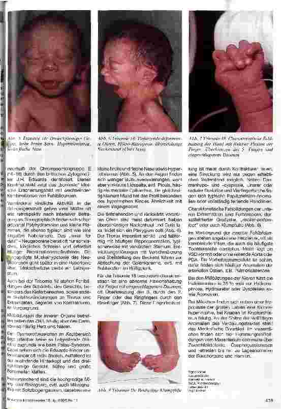Vorschauseite 2: Die Mißbildungssyndrome nach Patau und Edwards