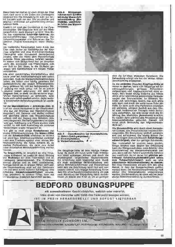 Vorschauseite 4: Einführung in die Hals - Nasen - Ohren - Heilkunde 4. Folge: Das Ohr Akute Erkrankungen des Mittelohres