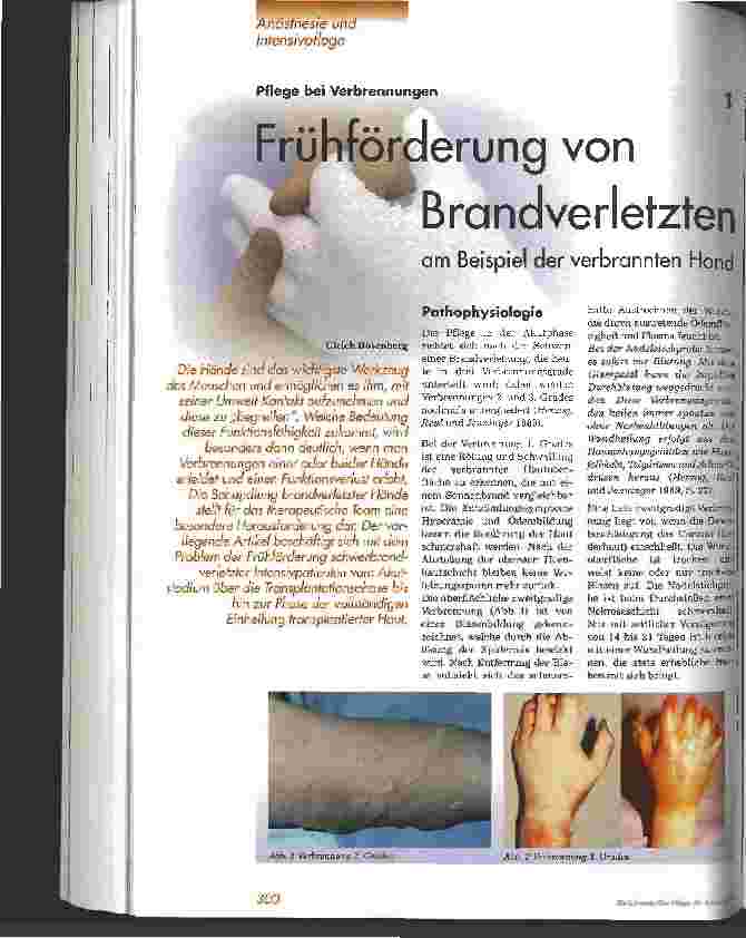 Vorschauseite 1: Frühförderung von Brandverletzten am Beispiel der verbrannten Hand