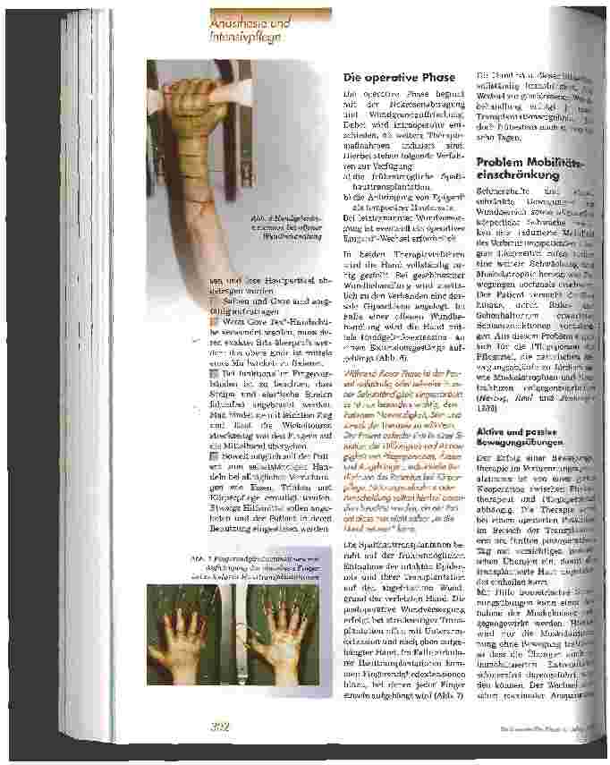 Vorschauseite 3: Frühförderung von Brandverletzten am Beispiel der verbrannten Hand