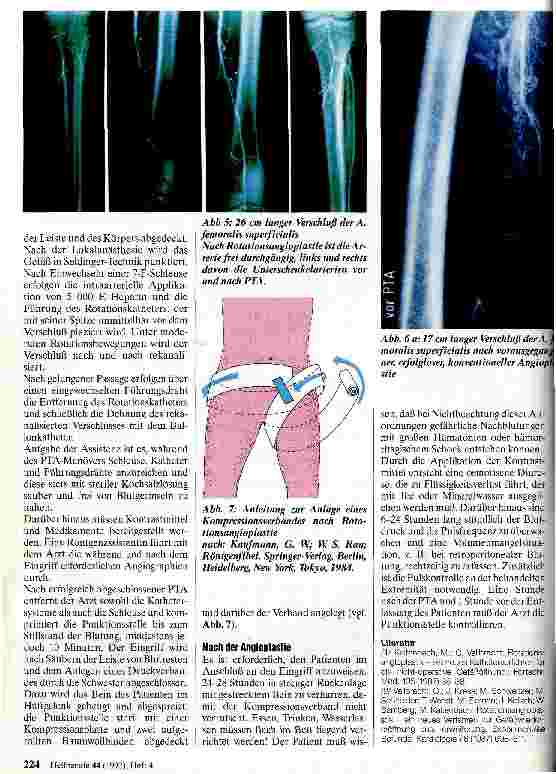 Vorschauseite 3: Behandlung der chronischen arteriellen Verschlußkrankheit mittels Rotationsangioplastie