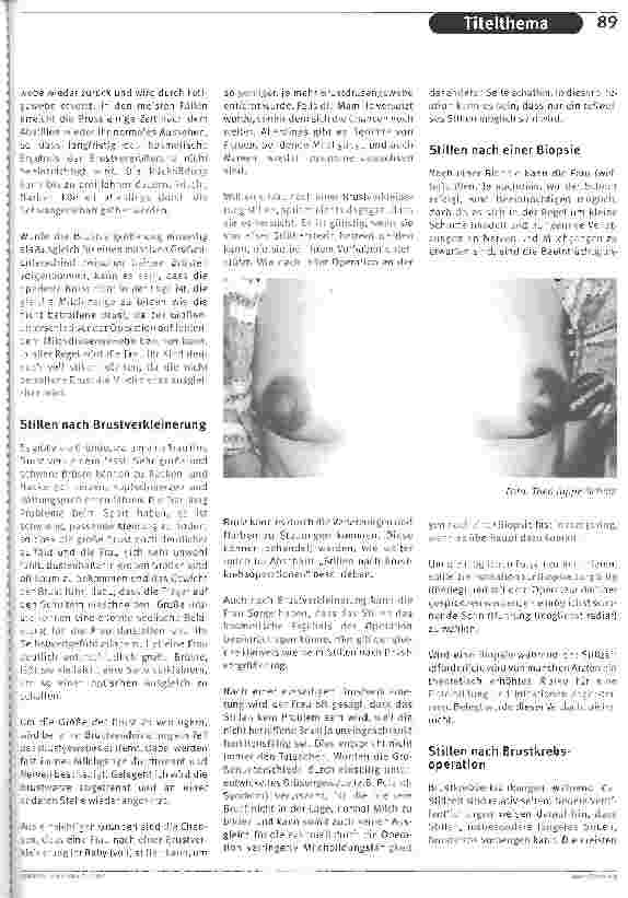 Vorschauseite 2: Stillen nach Brustoperationen