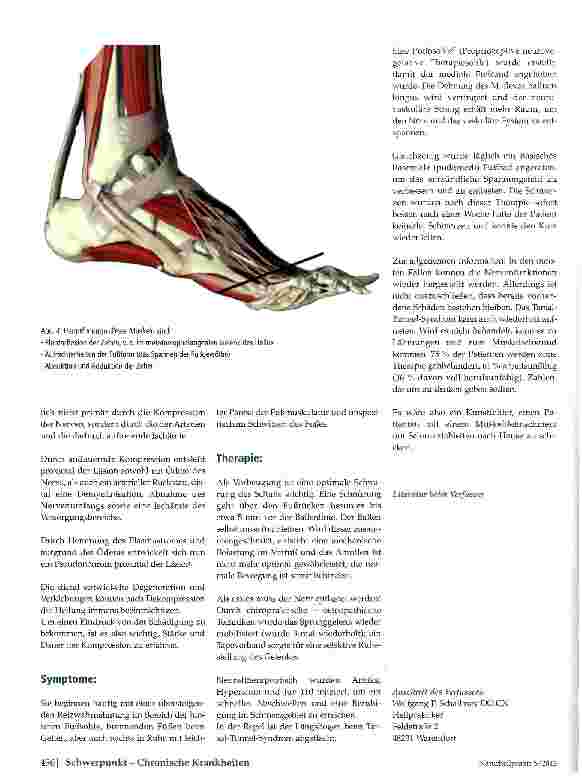 Vorschauseite 3: Das Tarsal-Tunnel-Syndrom