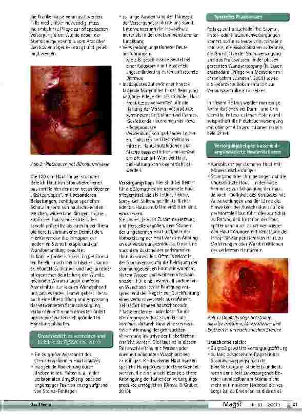 Vorschauseite 3: Peristomale Dermatitis Fistelund Wundversorgung bei Stomabetroffenen