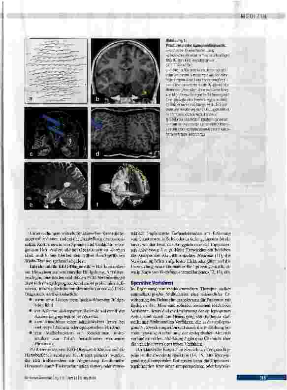 Vorschauseite 3: Prächirurgische Epilepsiediagnostik und operative Epilepsietherapie