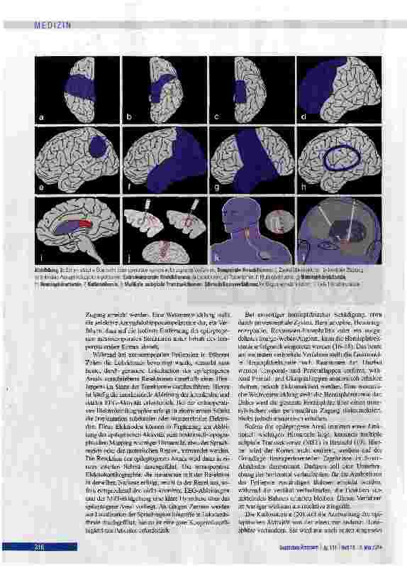 Vorschauseite 4: Prächirurgische Epilepsiediagnostik und operative Epilepsietherapie