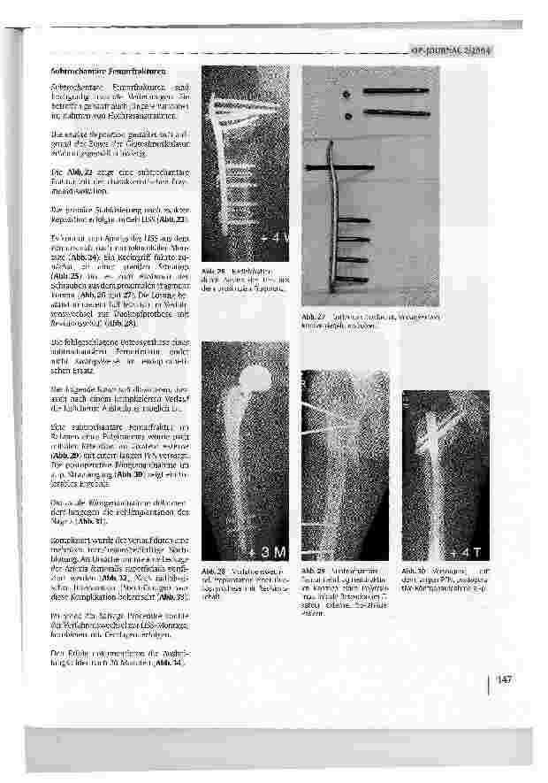 Vorschauseite 6: Perund subtrochantäre Femurfrakturen
