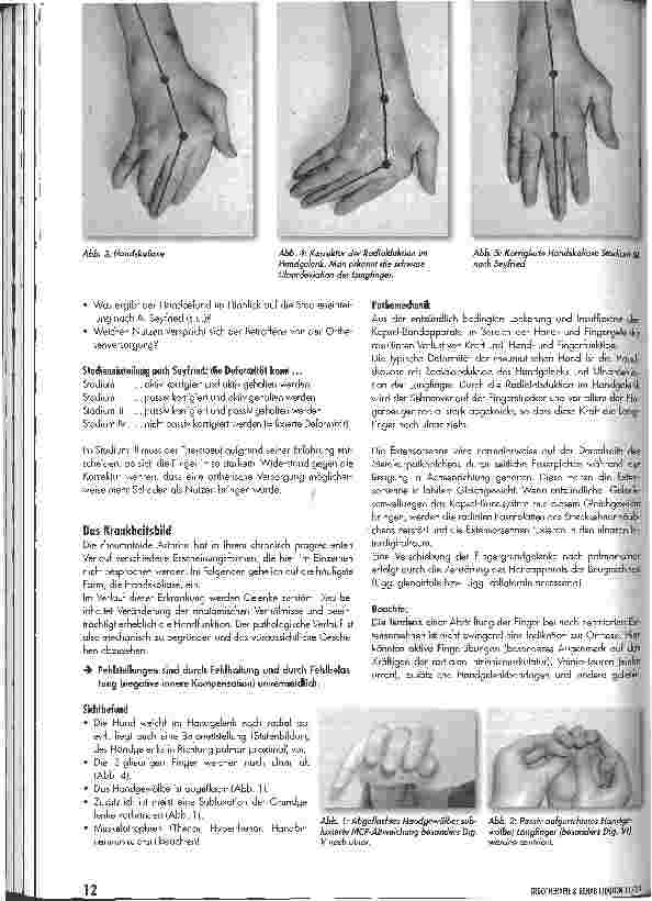 Vorschauseite 2: Die Anti-Ulnar-Drift-Spange (AUD)Hoffnungsträger für viele Patienten und Herausforderung für jeden Therapeuten