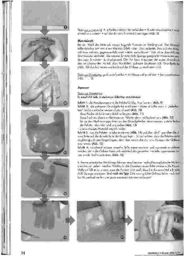 Vorschauseite 4: Die Anti-Ulnar-Drift-Spange (AUD)Hoffnungsträger für viele Patienten und Herausforderung für jeden Therapeuten