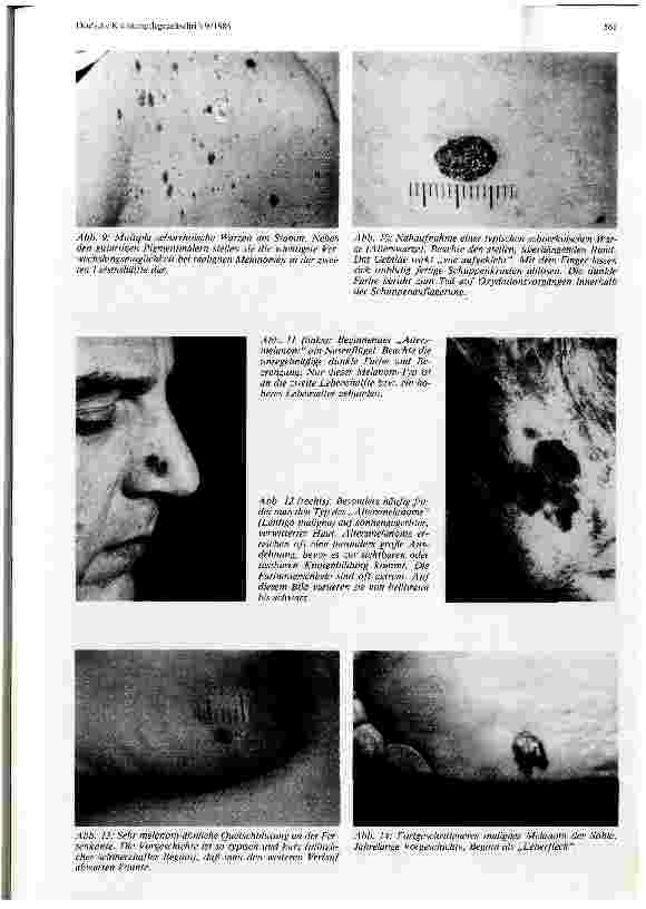 Vorschauseite 6: Früherkennung des malignen Melanoms