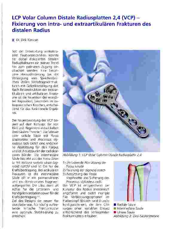 Vorschauseite 1: LCP Volar Column Distale Radiusplatten 2, 4 (VCP) -Fixierung von intraund extraartikulären Frakturen des distalen Radius