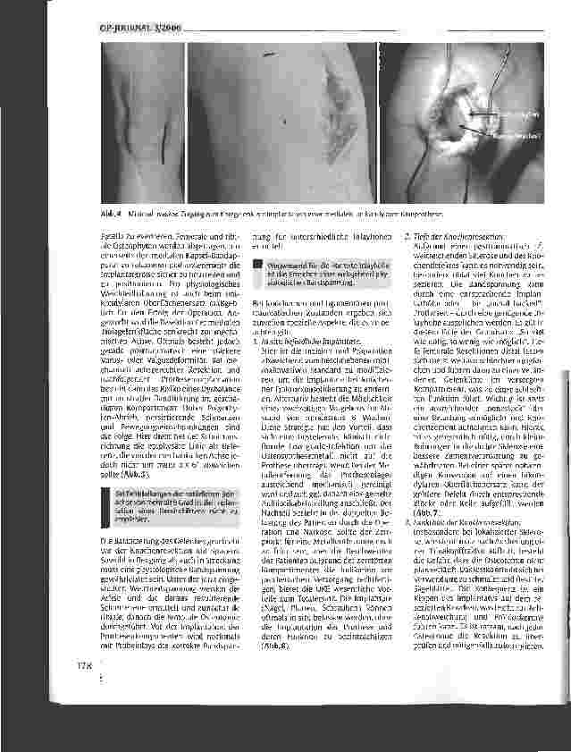 Vorschauseite 3: Posttraumatische unikondyläre Knieendoprothetik