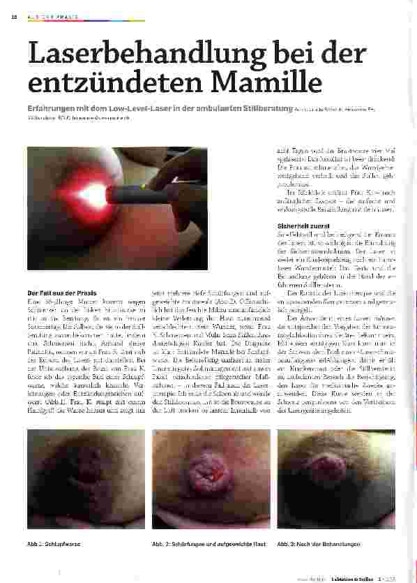 Vorschauseite 1: Laserbehandluns bei der entzündeten Mamille