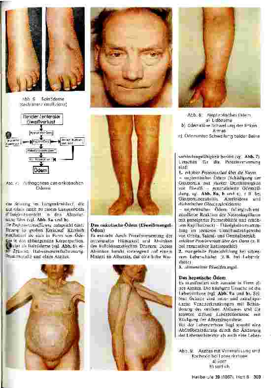 Vorschauseite 3: Die Pathognese der Ödembildung