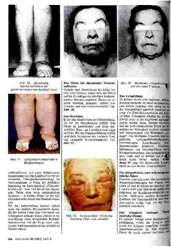 Vorschauseite 4: Die Pathognese der Ödembildung