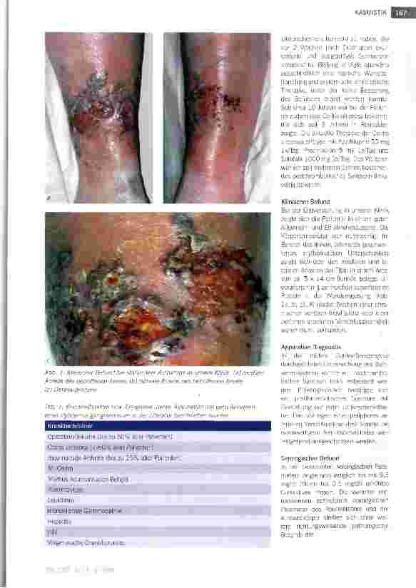 Vorschauseite 2: Pyoderma gangraenosum bei Colitis ulcerosa: Eine seltene Ursache eines Ulcus cruris