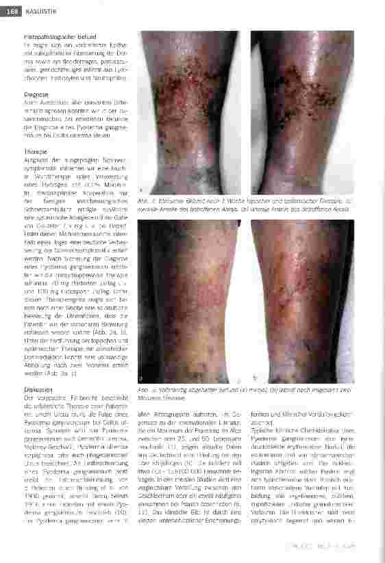 Vorschauseite 3: Pyoderma gangraenosum bei Colitis ulcerosa: Eine seltene Ursache eines Ulcus cruris