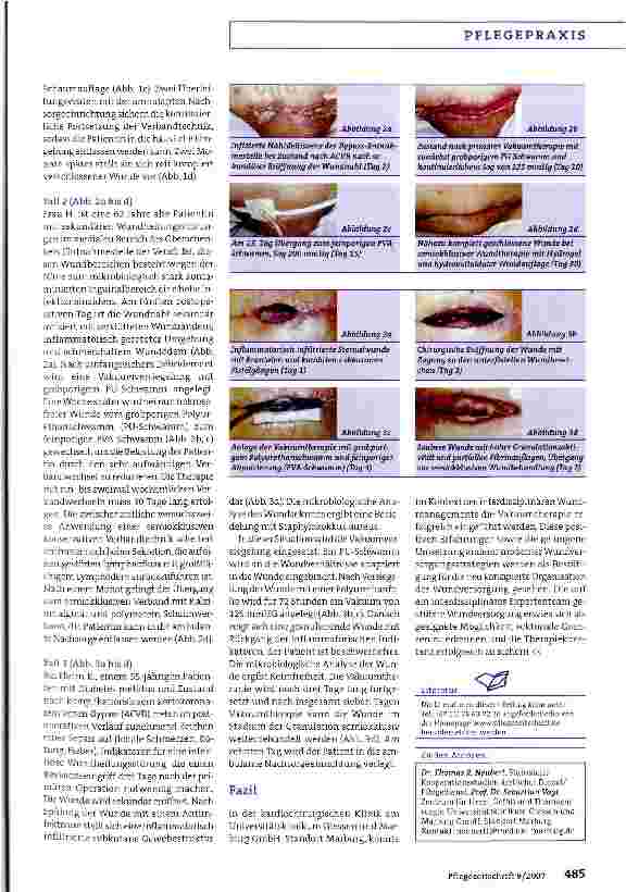 Vorschauseite 4: Vakuumversiegelung in der Kardiochirurgie
