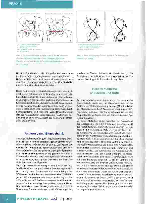 Vorschauseite 2: Der Innenrotationsgang Spezielle Ursache Anteversion des Acetabulums