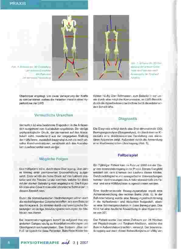 Vorschauseite 4: Der Innenrotationsgang Spezielle Ursache Anteversion des Acetabulums