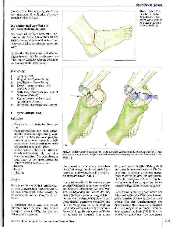 Vorschauseite 2: Amputation an den unteren Extremitäten Unterschenkel: Indikation, Technik