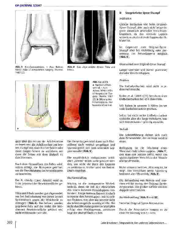 Vorschauseite 3: Amputation an den unteren Extremitäten Unterschenkel: Indikation, Technik