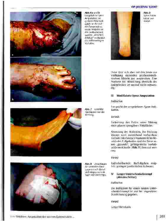 Vorschauseite 4: Amputation an den unteren Extremitäten Unterschenkel: Indikation, Technik